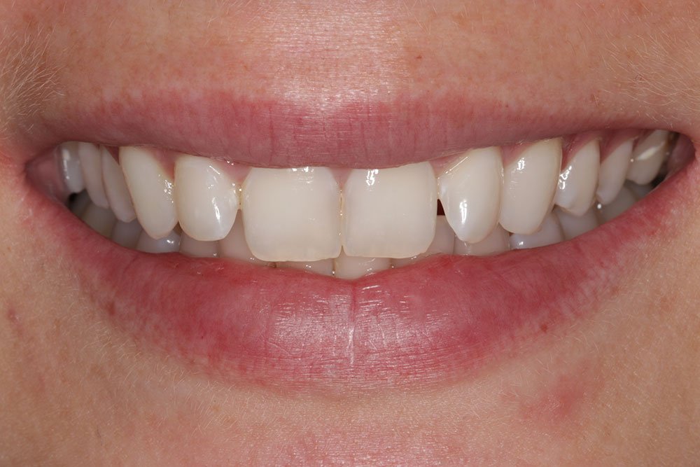 Composite Bonding Before and After