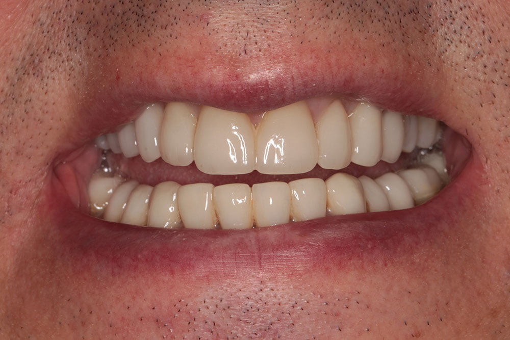 Digital Smile Design Before and After