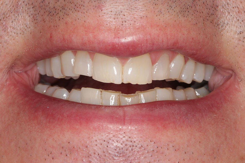 Digital Smile Design Before and After