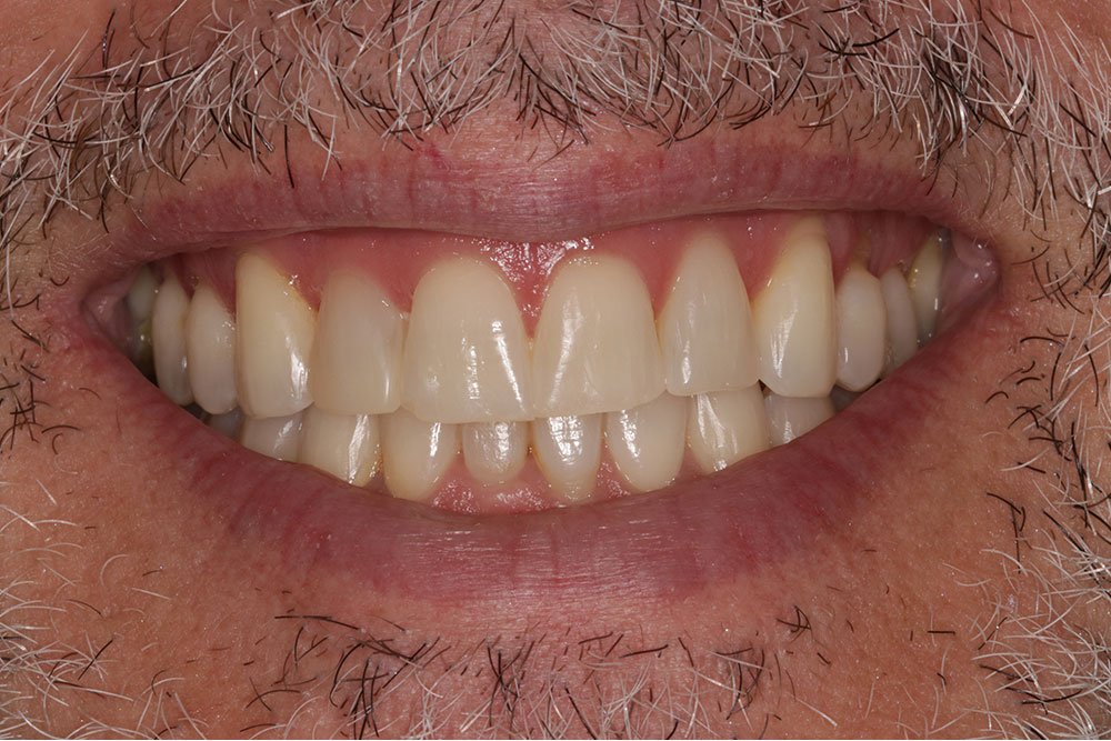 Composite Bonding Before and After