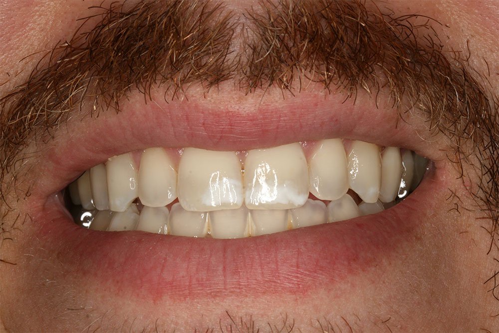 Invisalign Before and After