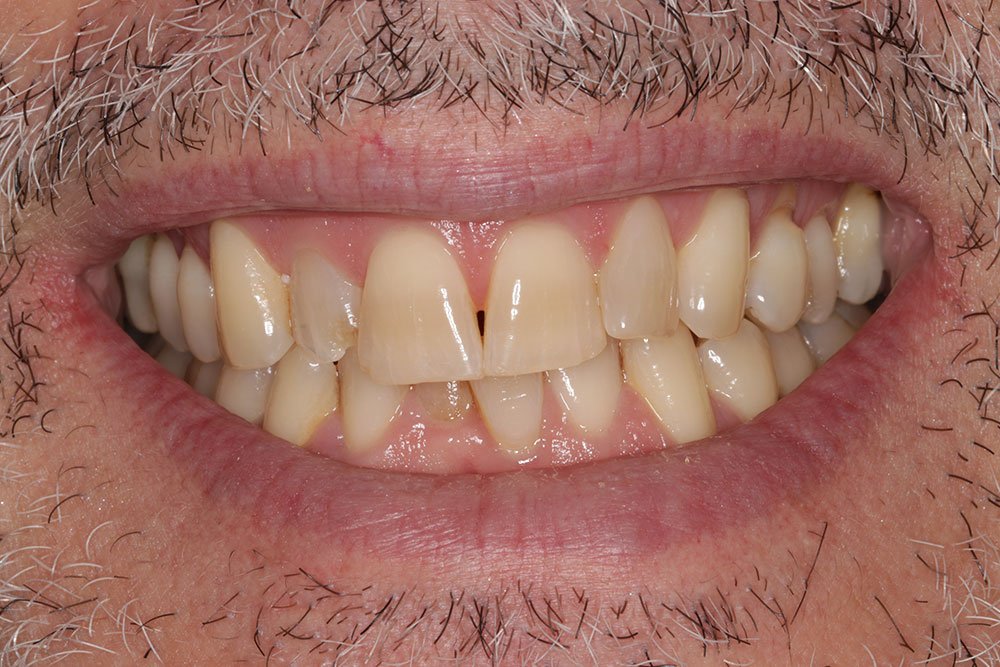 Composite Bonding Before and After
