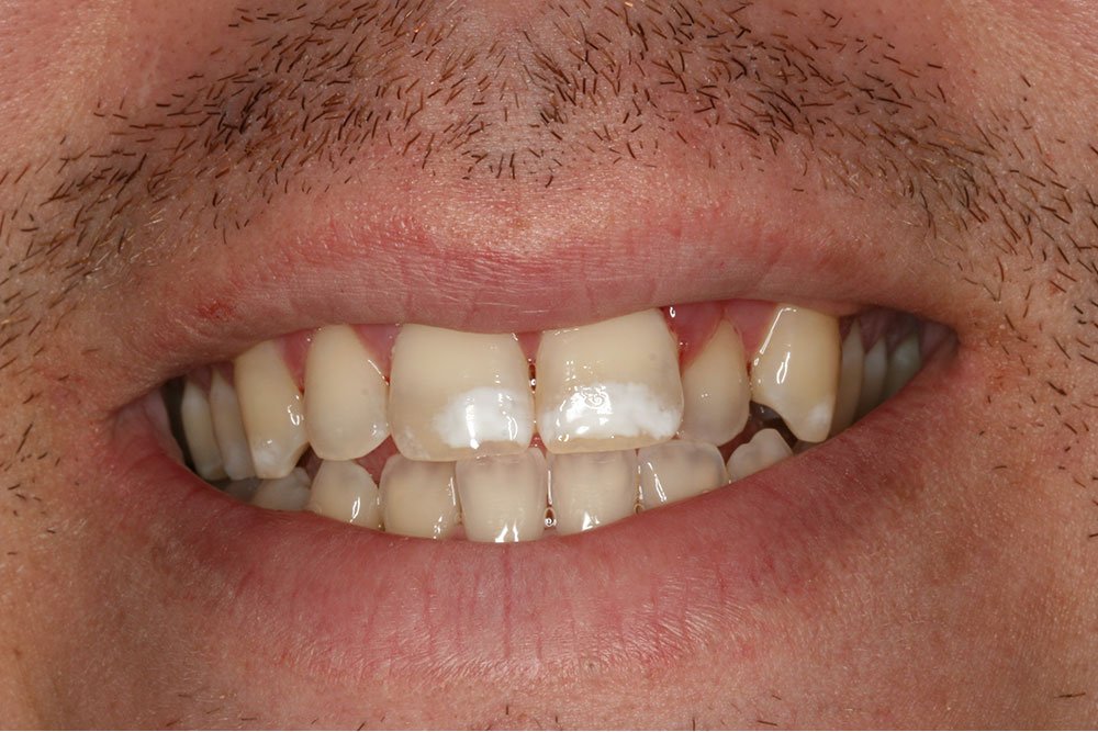 Invisalign Before and After