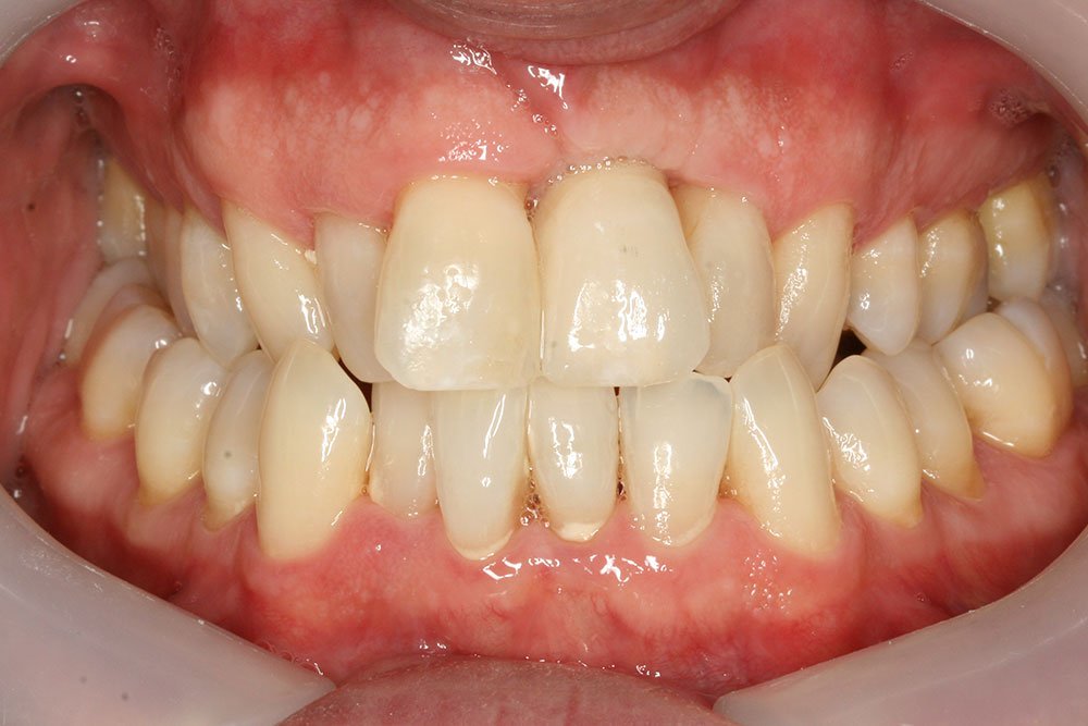 Dental Implants Before and After