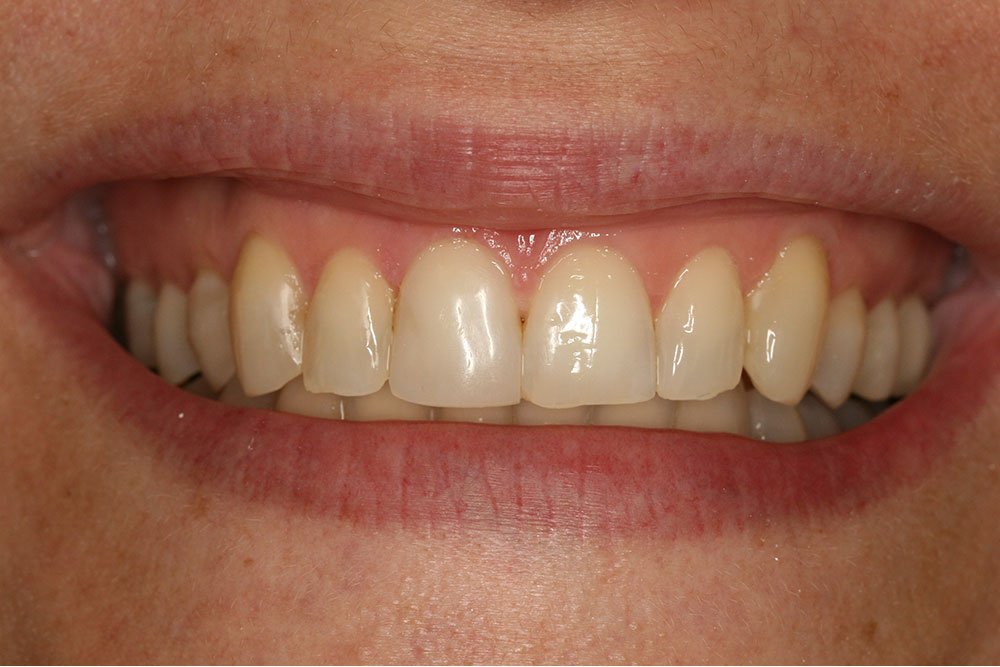 Composite Bonding Before and After