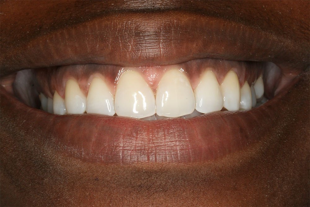Invisalign Before and After
