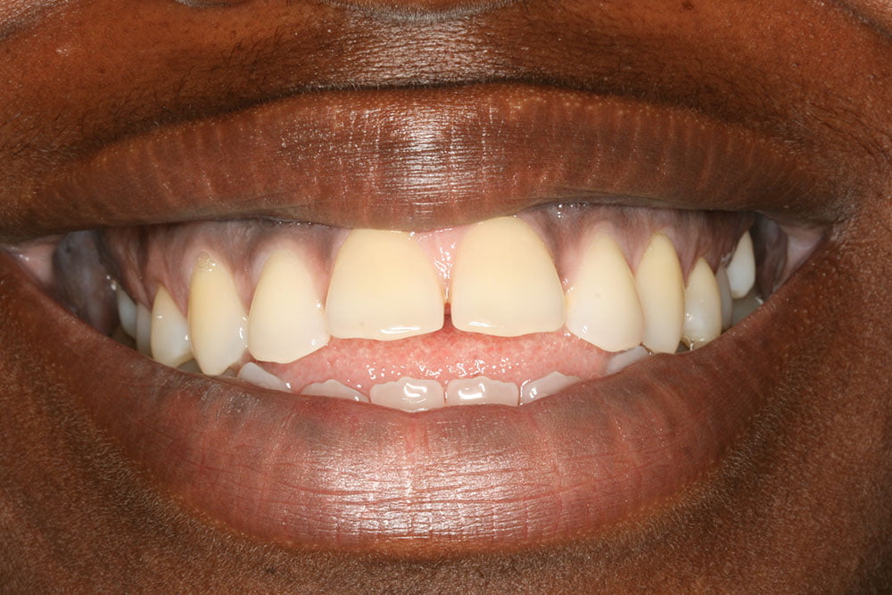 Invisalign Before and After