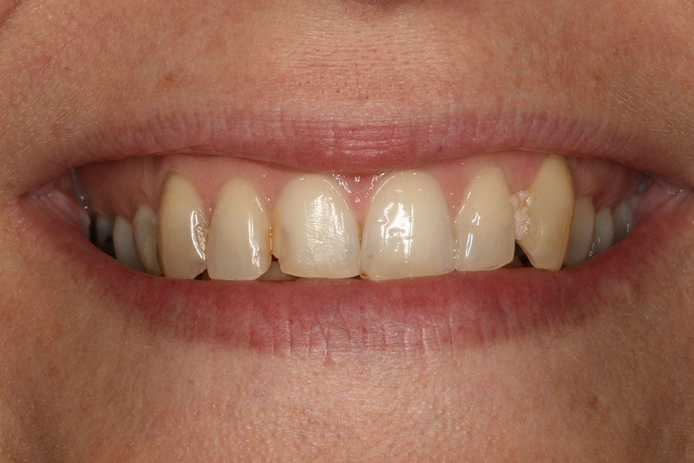 Composite Bonding Before and After