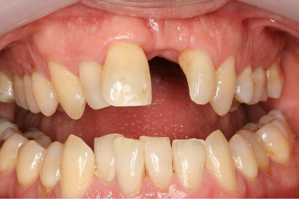 Dental Implants Before and After