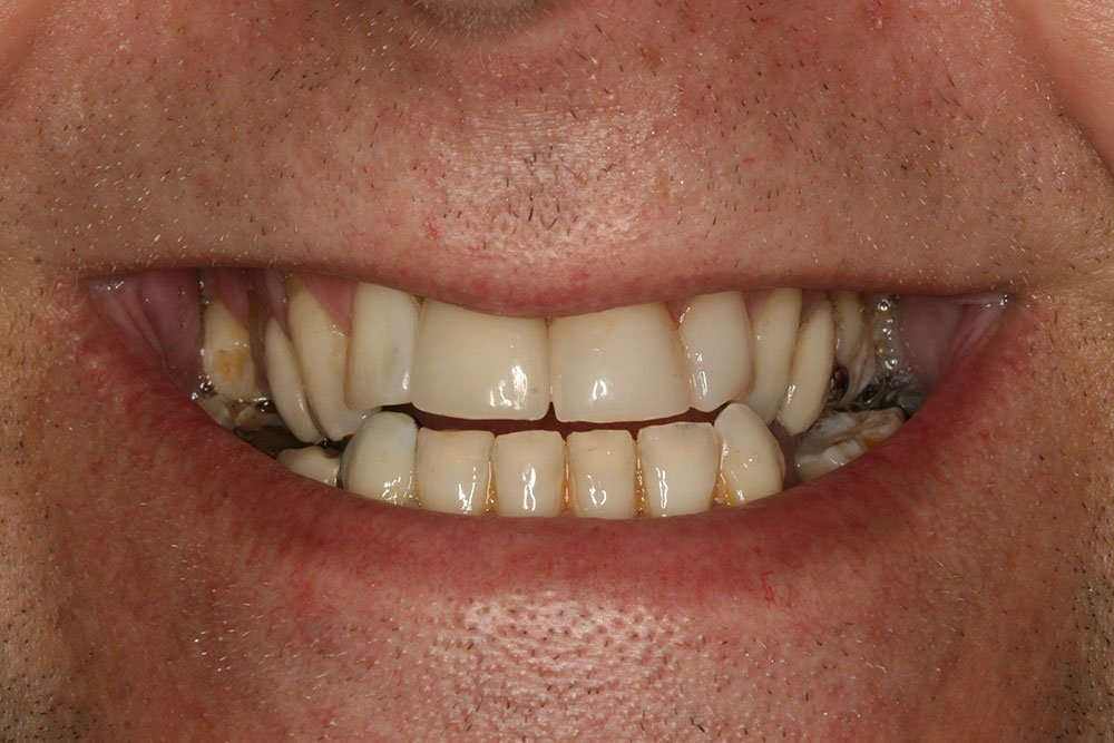 Dental Implants Before and After