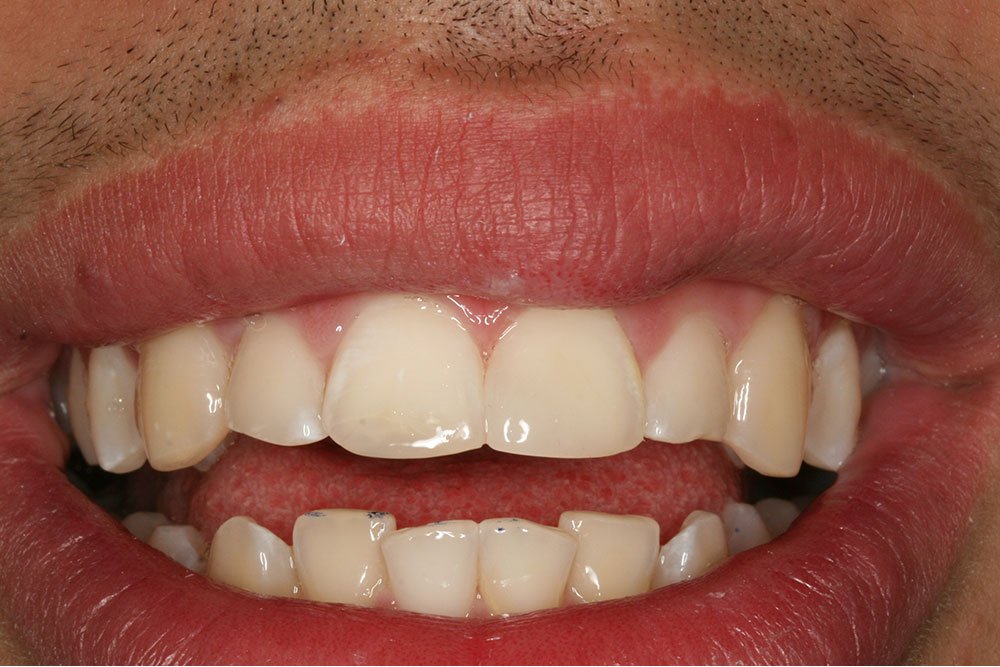 Composite Bonding Before and After