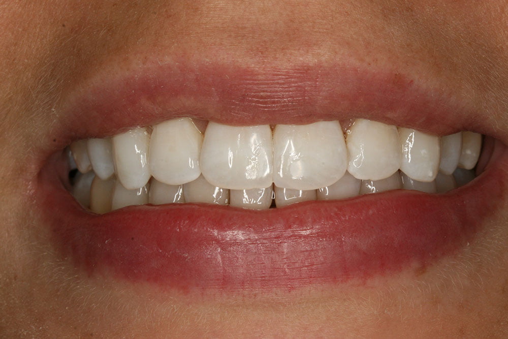 Invisalign Before and After