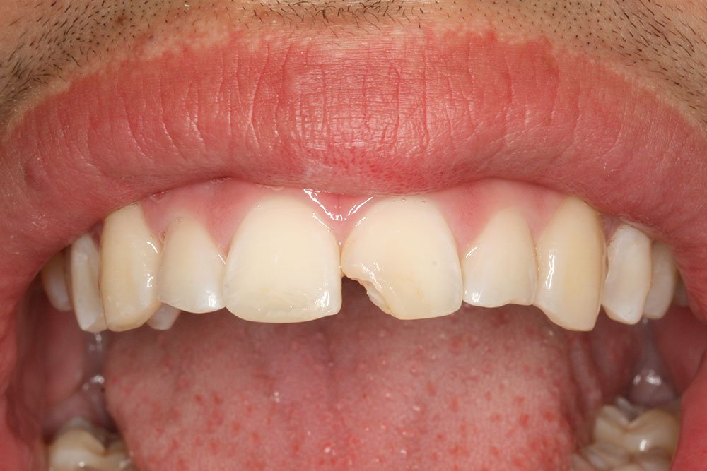 Composite Bonding Before and After