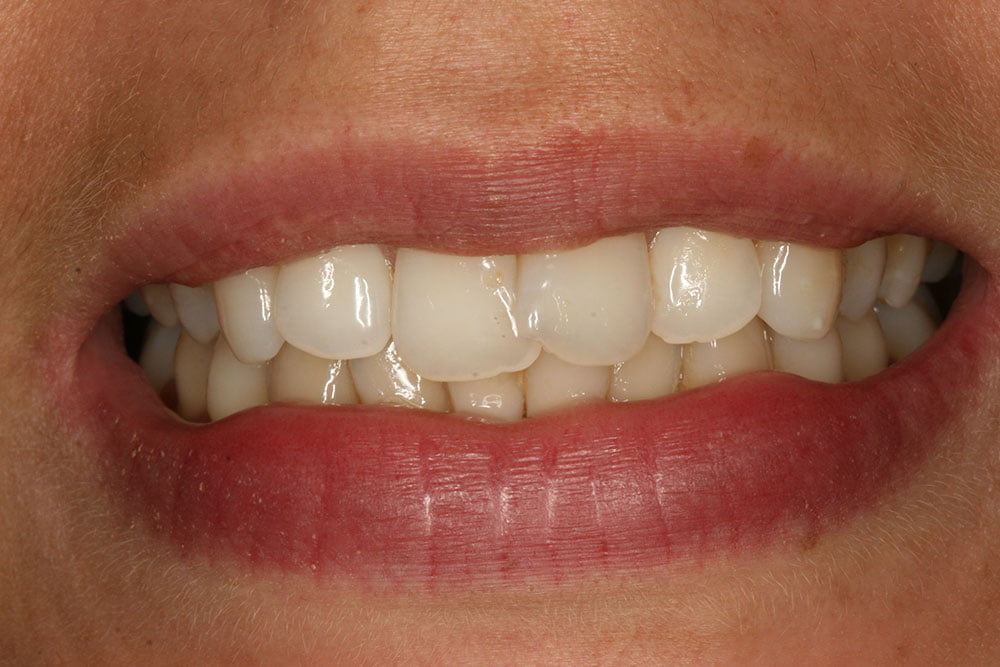 Invisalign Before and After