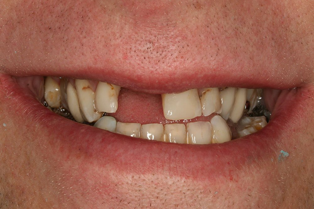 Dental Implants Before and After