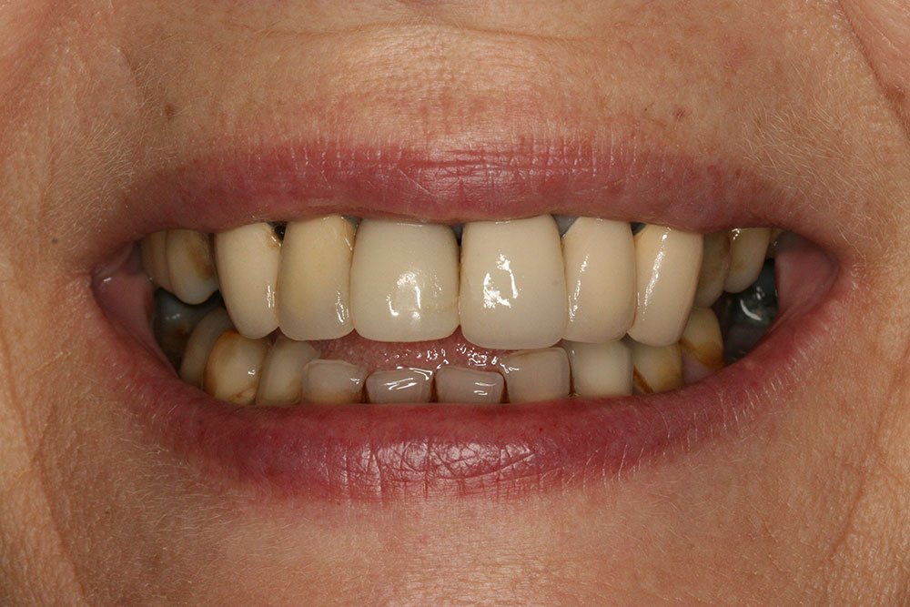 Digital Smile Design Before and After