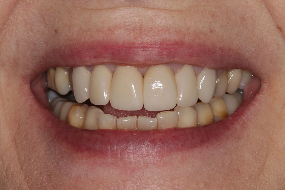 Digital Smile Design Before and After