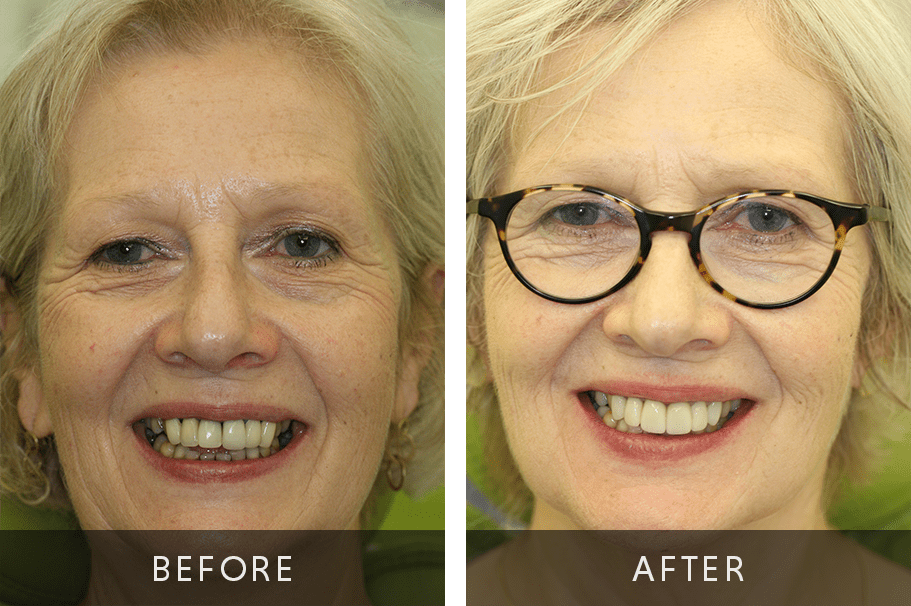 Digital Smile Design Before and After