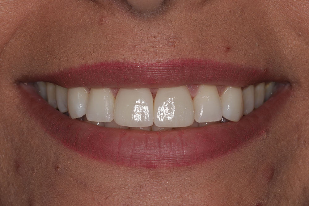 Digital Smile Design Before and After
