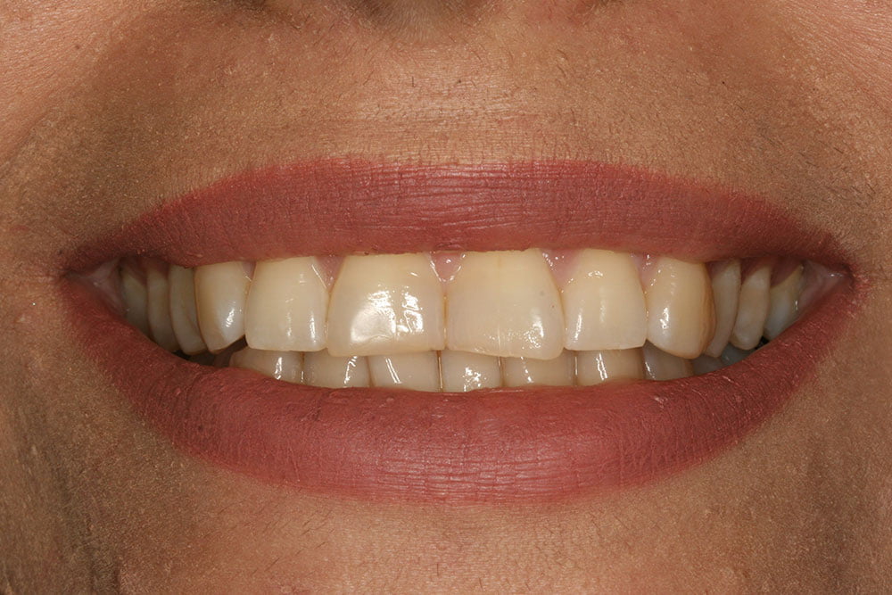 Digital Smile Design Before and After