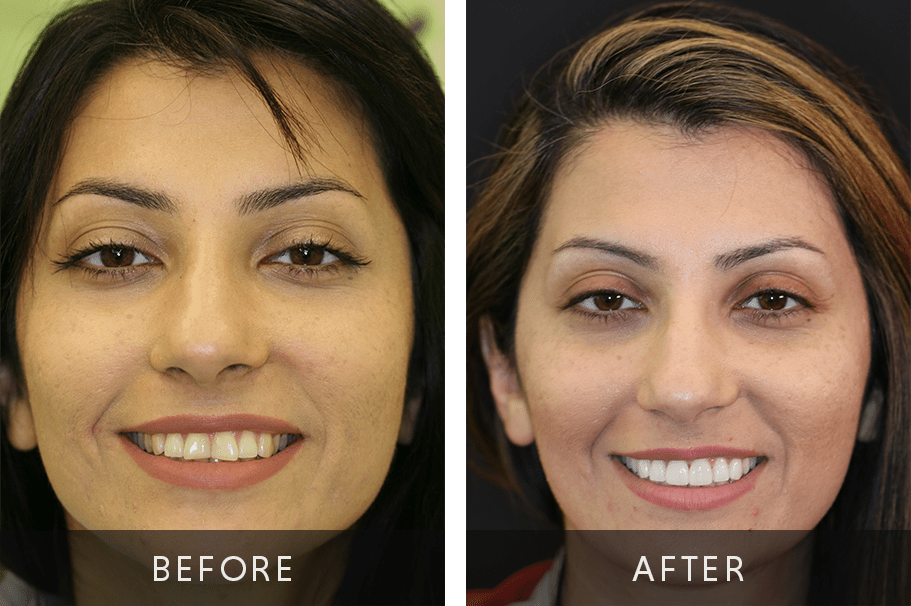 Digital Smile Design Before and After