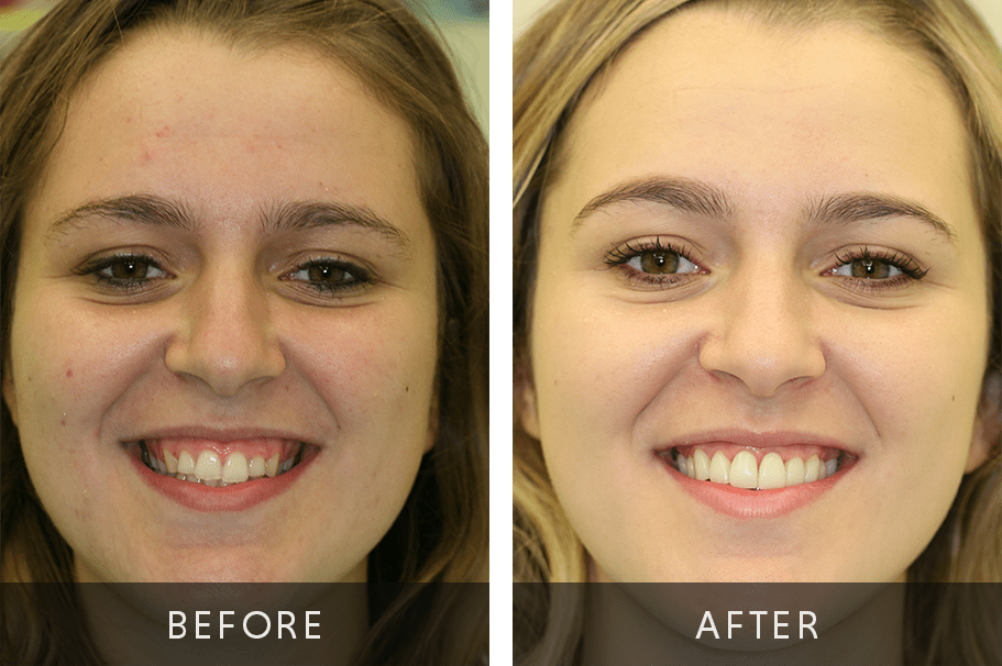 Digital Smile Design Before and After