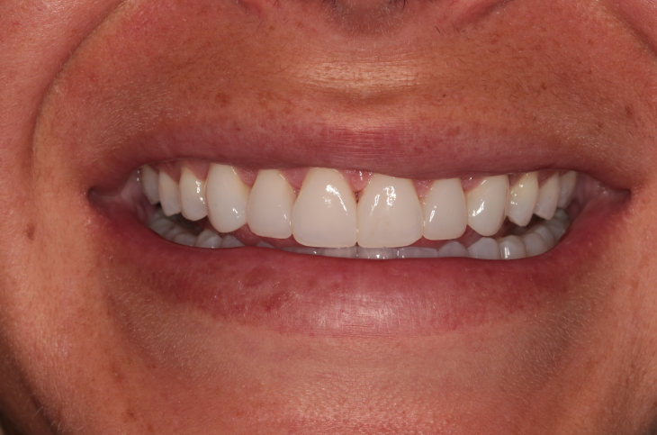 Composite Bonding Before and After