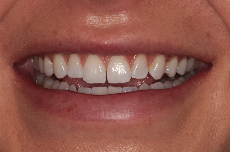 Composite Bonding Before and After