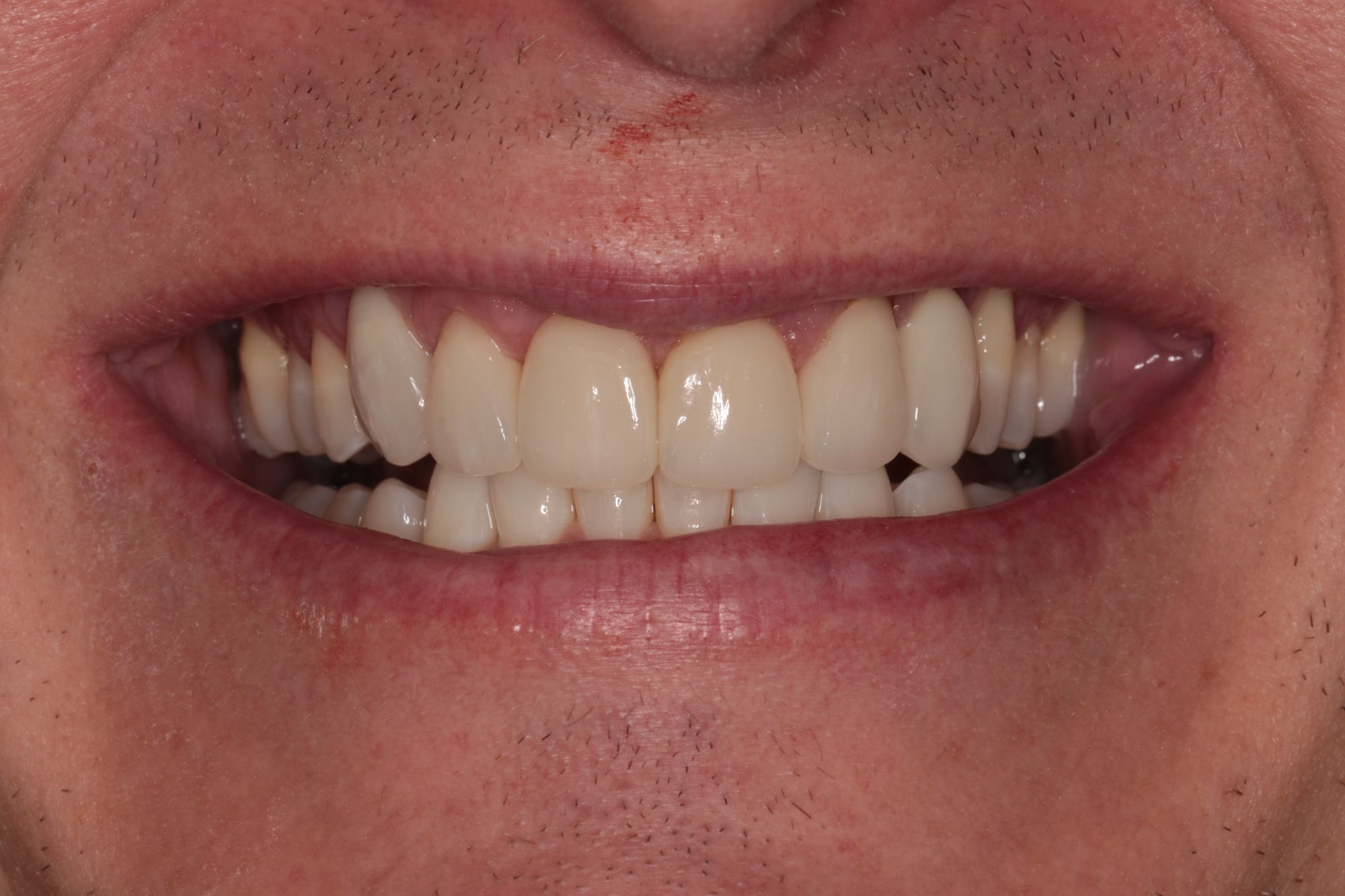Dental Veneers Before and After