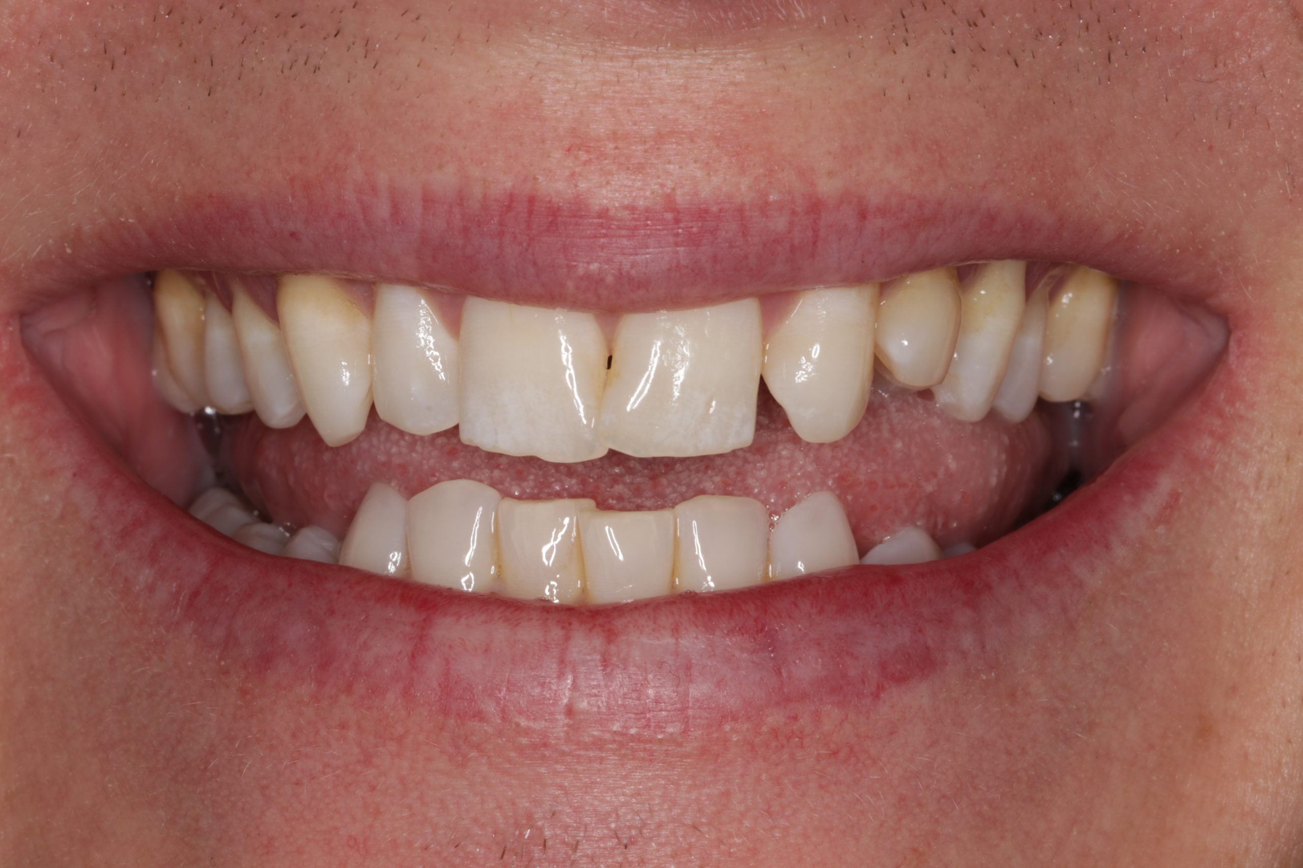 Dental Veneers Before and After