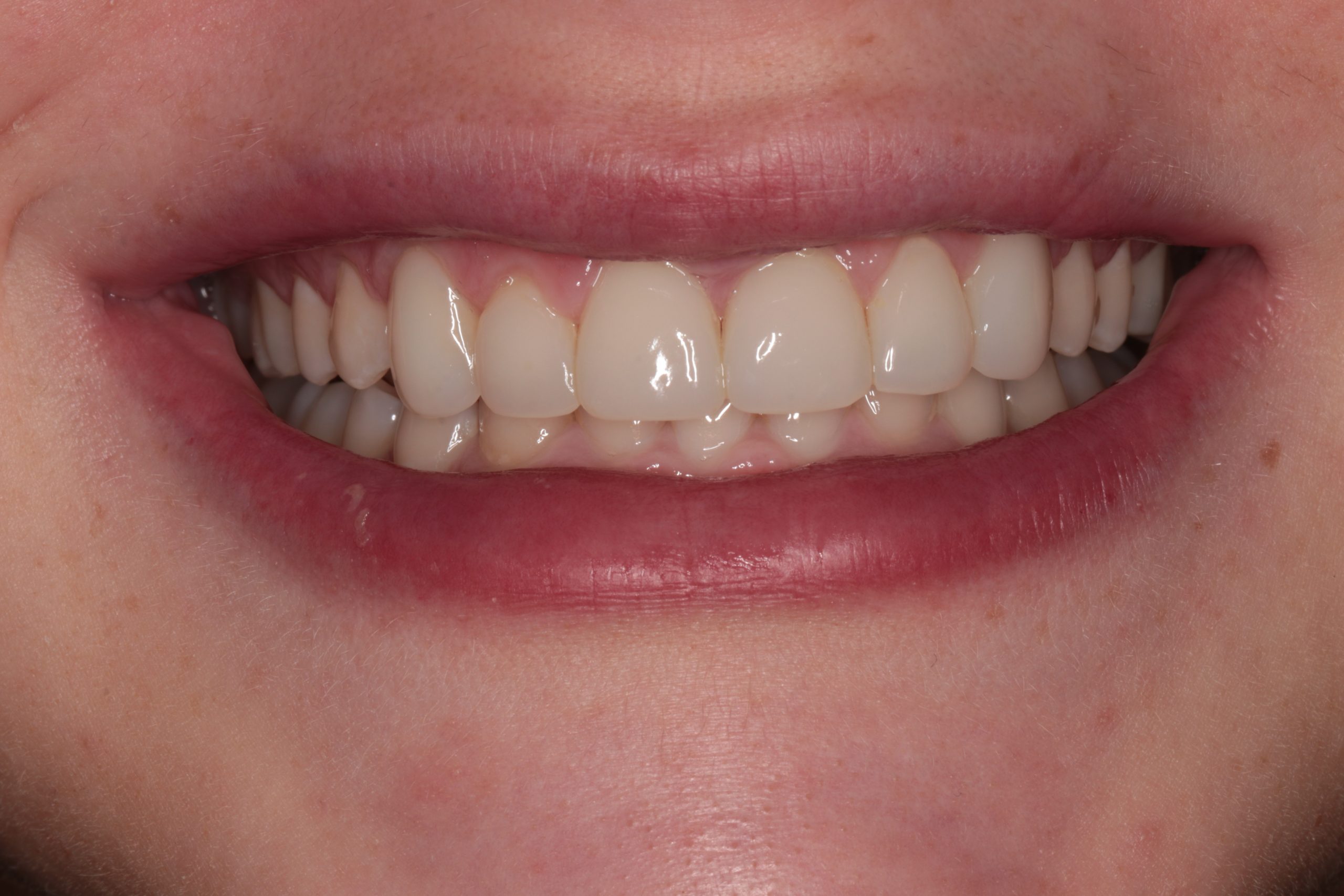 Composite Bonding Before and After