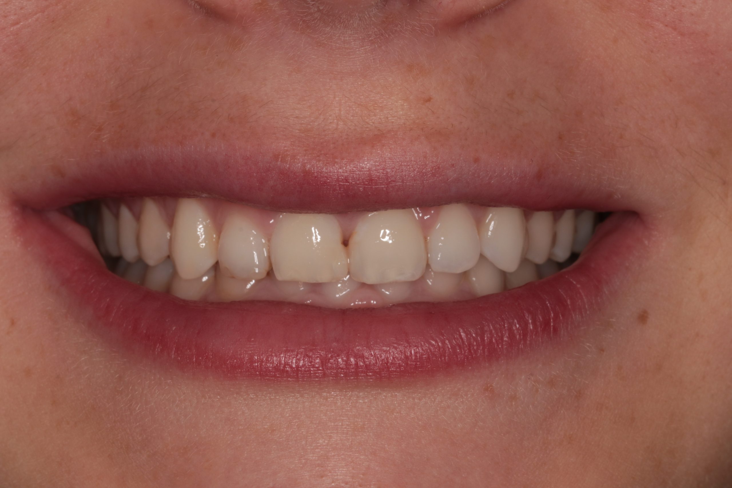 Composite Bonding Before and After